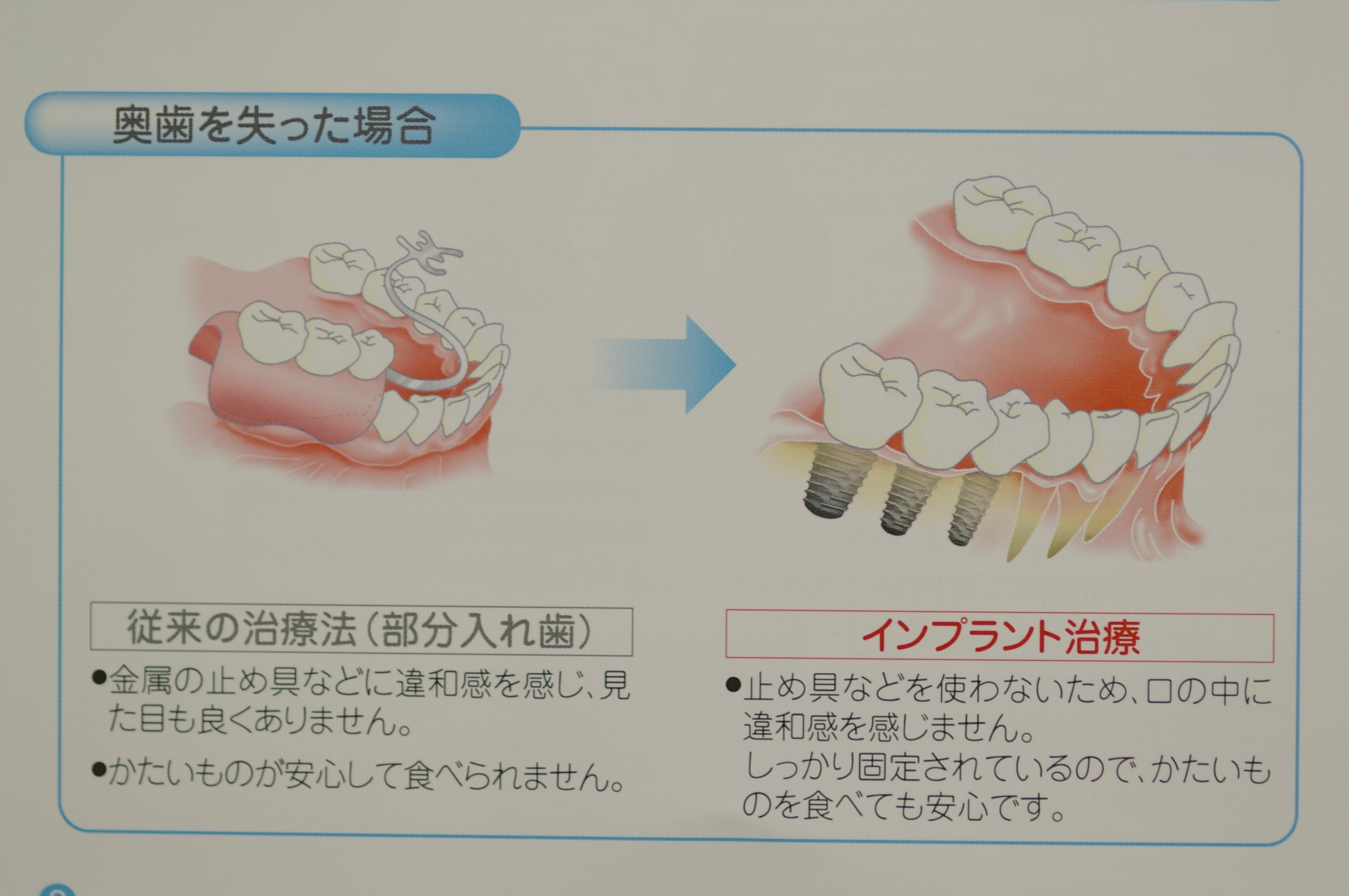 入れ歯からインプラントに移行した例